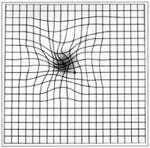 an abnormal amsler grid