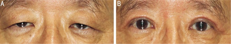 dermatochalasis patient