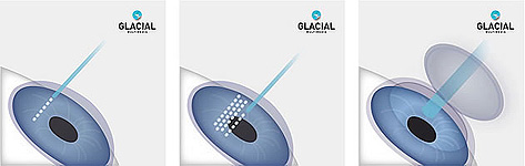 blade_free_lasik
