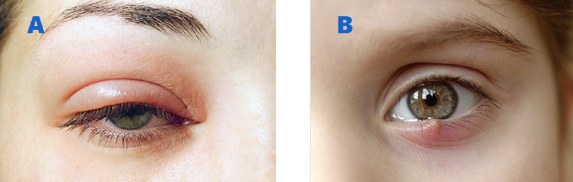 chalazion and stye patients