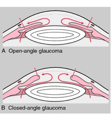 glaucoma_photo