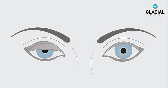 ptosis