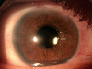 Eye after receiving artificial lens. 