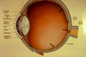 Narrow Angle Glaucoma Facts