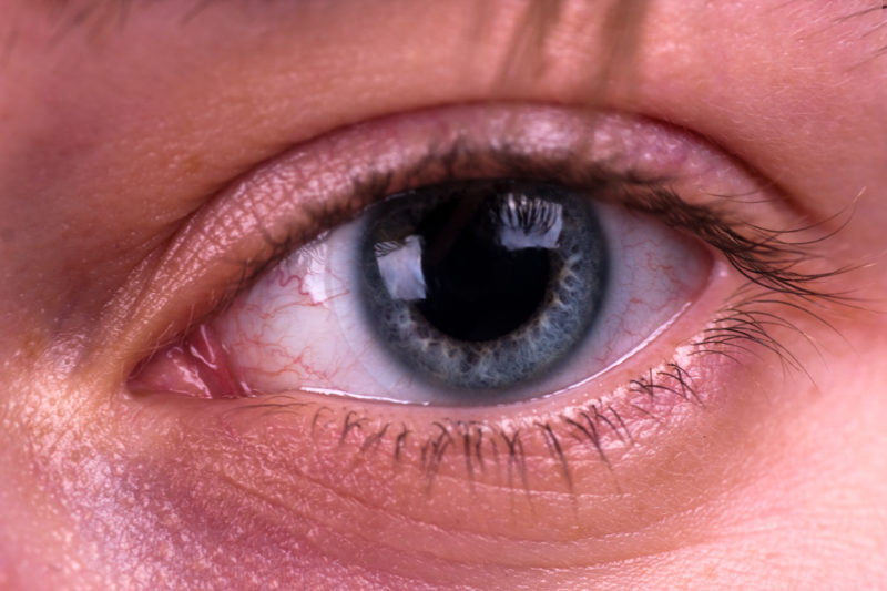 dorp levering Zuivelproducten Can I Be Allergic To Contacts? Common FAQs - Eye Consultants
