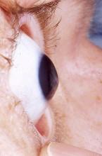 Up close of eye to see keratoconus