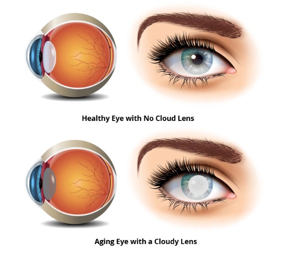 Cataract Surgery in Atlanta