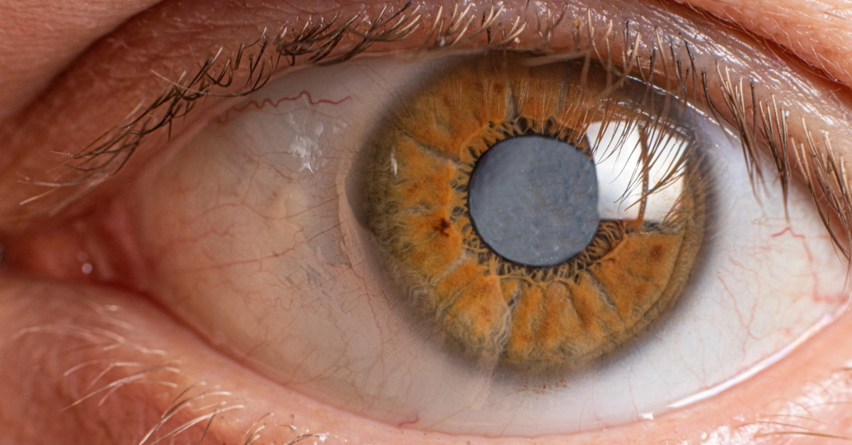 Debunking Myths About Cataracts