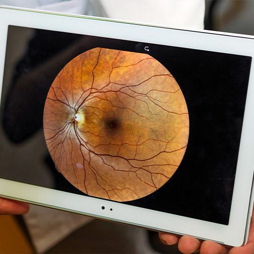 A fundus image showing retina.