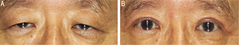 dermatochalasis patient