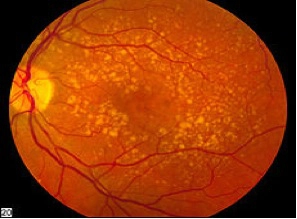 mild macular degeneration