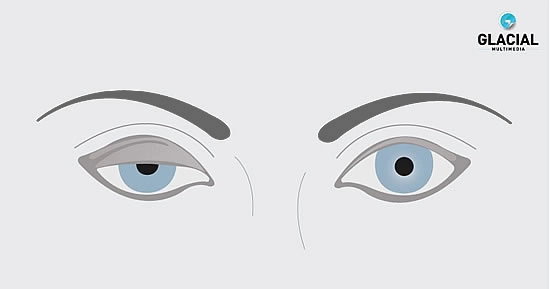 ptosis