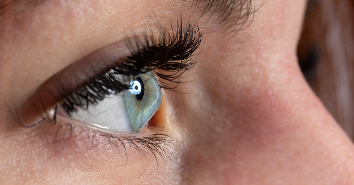 Close up of eye with Keratoconus